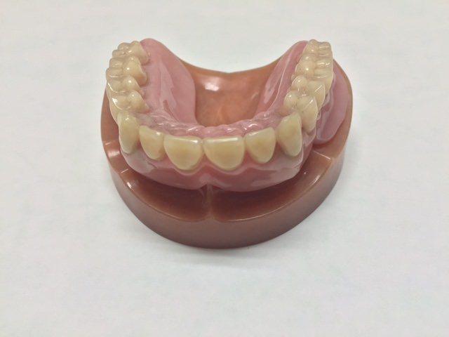 磁性アタッチメント義歯1